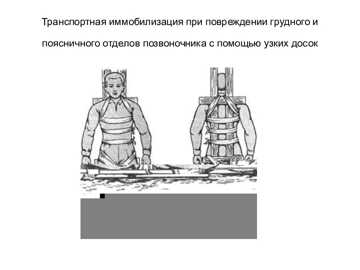 Транспортная иммобилизация при повреждении грудного и поясничного отделов позвоночника с помощью узких досок