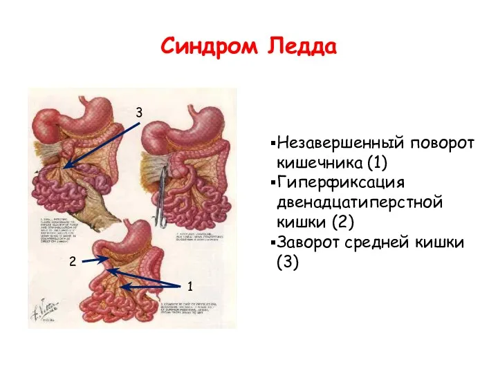 Синдром Ледда Незавершенный поворот кишечника (1) Гиперфиксация двенадцатиперстной кишки (2) Заворот средней кишки