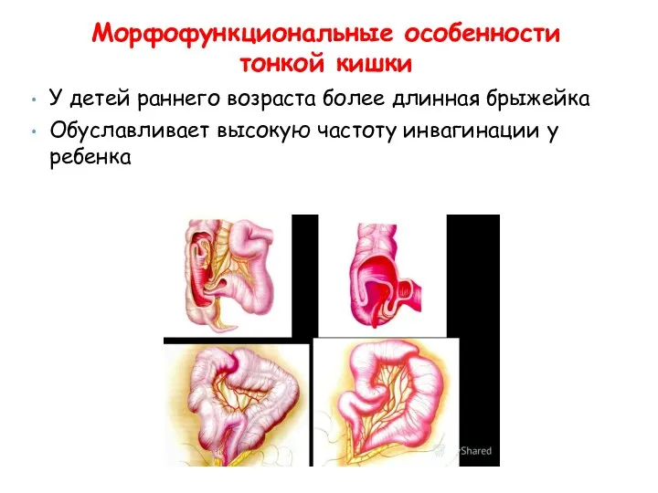 У детей раннего возраста более длинная брыжейка Обуславливает высокую частоту инвагинации у ребенка