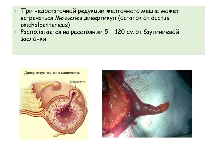 При недостаточной редукции желточного мешка может встречаться Меккелев дивертикул (остаток от ductus omphaloentericus)