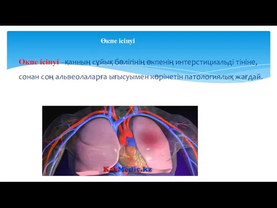 Өкпе ісінуі –қанның сұйық бөлігінің өкпенің интерстициальді тініне, сонан соң