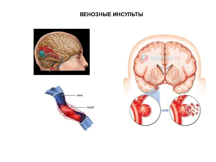 ВЕНОЗНЫЕ ИНСУЛЬТЫ