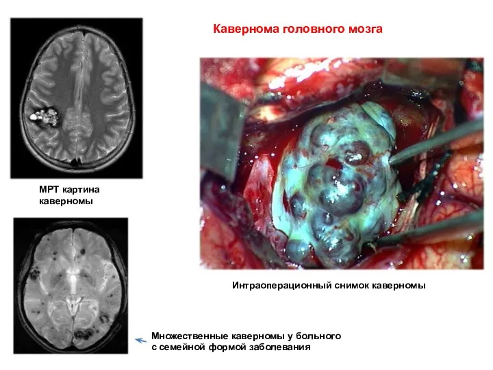 Кавернома головного мозга МРТ картина каверномы Интраоперационный снимок каверномы Множественные