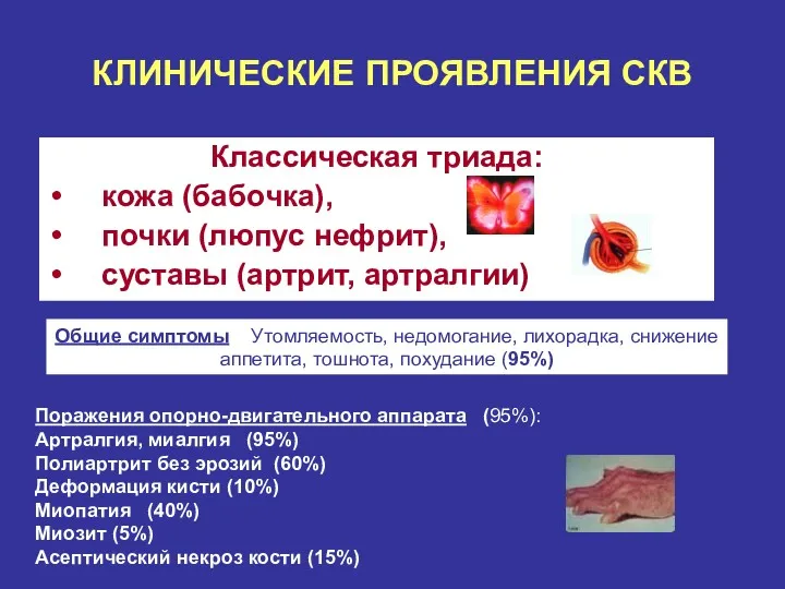 КЛИНИЧЕСКИЕ ПРОЯВЛЕНИЯ СКВ Классическая триада: кожа (бабочка), почки (люпус нефрит),