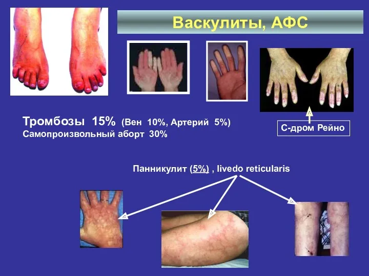 Васкулиты, АФС Панникулит (5%) , livedo reticularis Тромбозы 15% (Вен