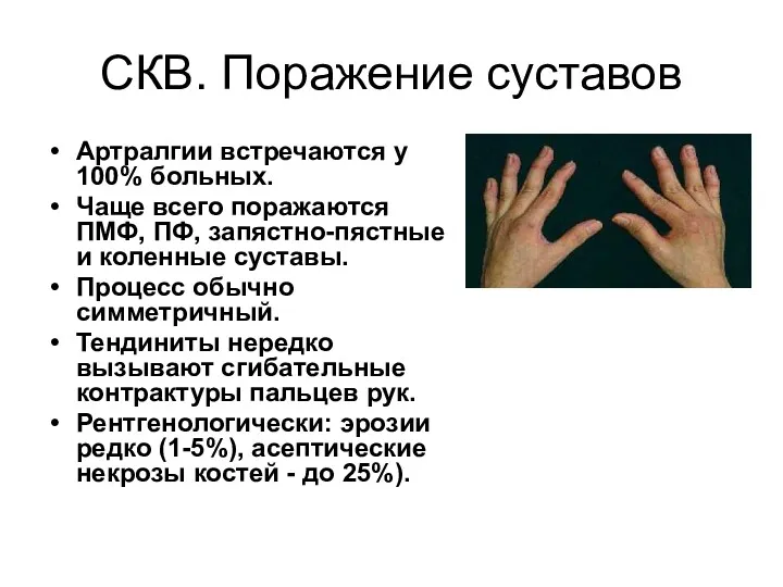 СКВ. Поражение суставов Артралгии встречаются у 100% больных. Чаще всего