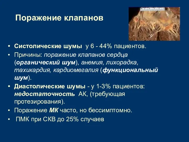 Поражение клапанов Систолические шумы у 6 - 44% пациентов. Причины: