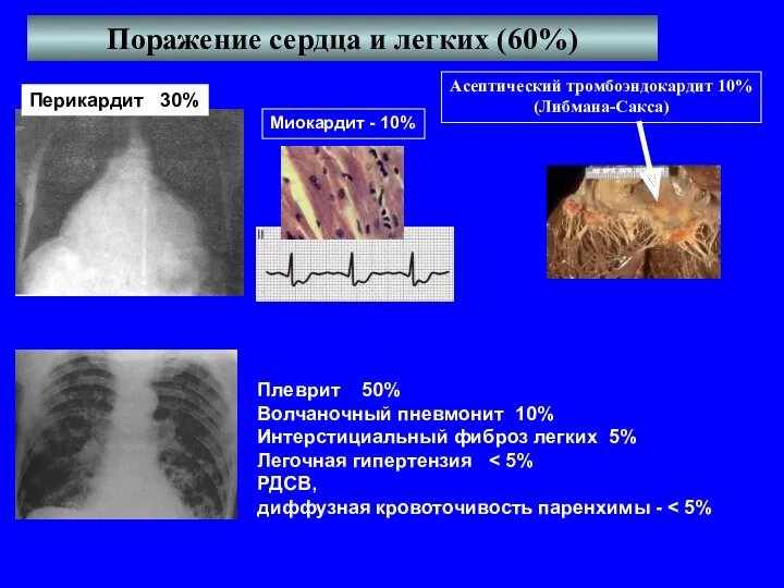 Поражение сердца и легких (60%) Миокардит - 10% Перикардит 30%