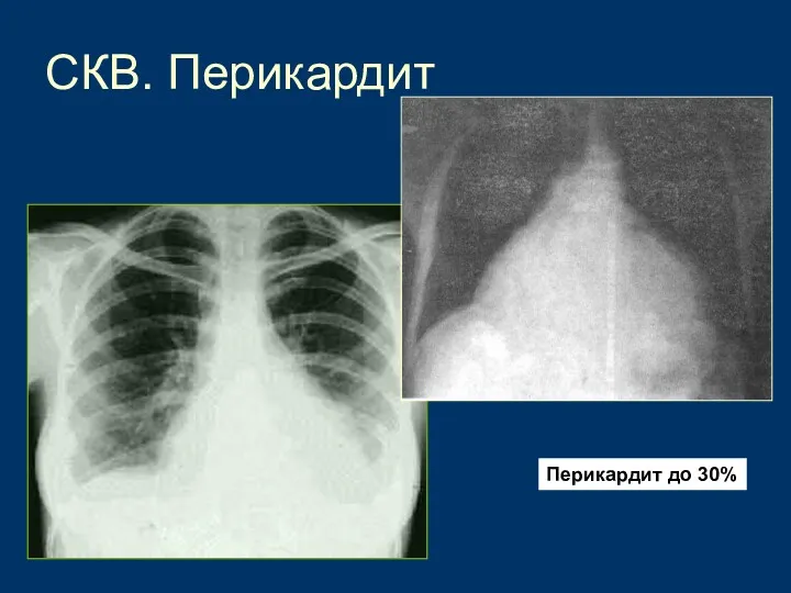 СКВ. Перикардит Перикардит до 30%