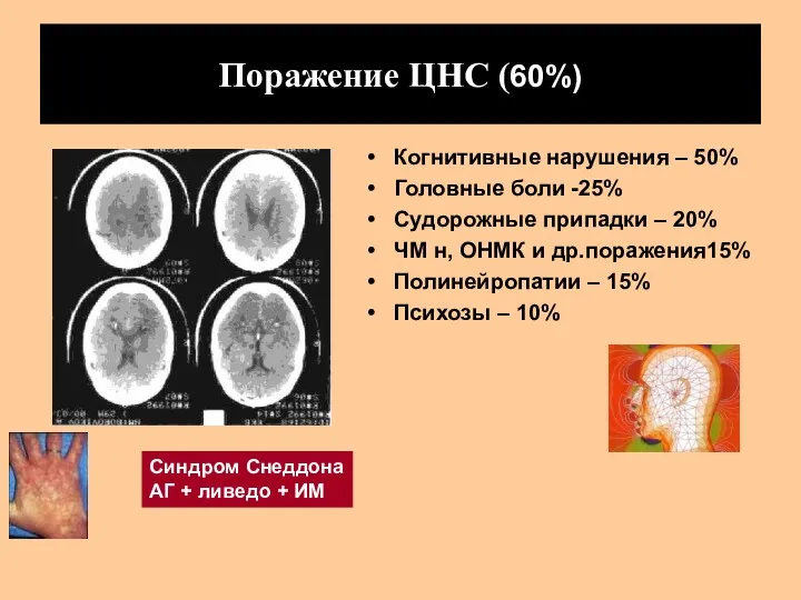 Поражение ЦНС (60%) Когнитивные нарушения – 50% Головные боли -25%