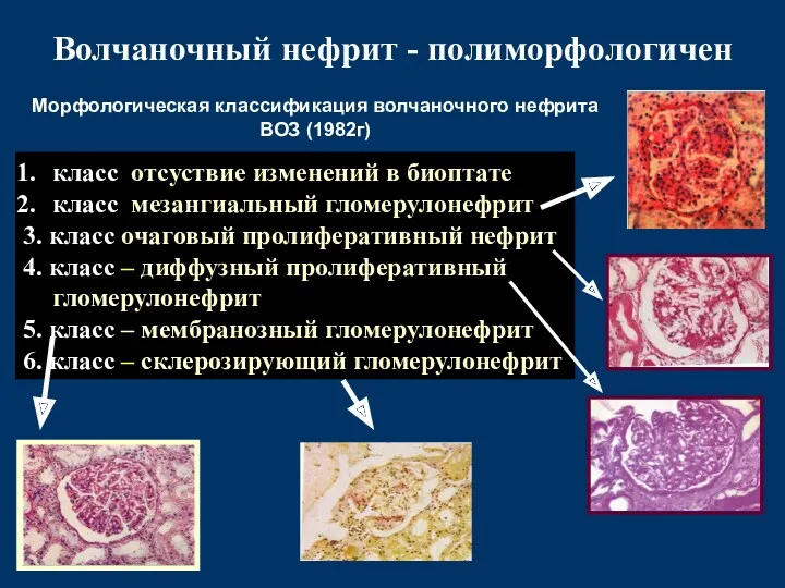 Волчаночный нефрит - полиморфологичен класс отсуствие изменений в биоптате класс