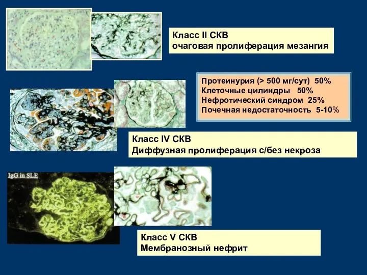 Класс II СКВ очаговая пролиферация мезангия Класс IV СКВ Диффузная