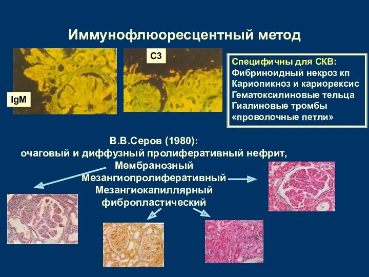 Иммунофлюоресцентный метод IgM С3 В.В.Серов (1980): очаговый и диффузный пролиферативный