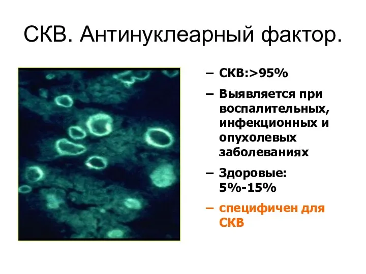 СКВ. Антинуклеарный фактор. СКВ:>95% Выявляется при воспалительных, инфекционных и опухолевых заболеваниях Здоровые: 5%-15% специфичен для СКВ