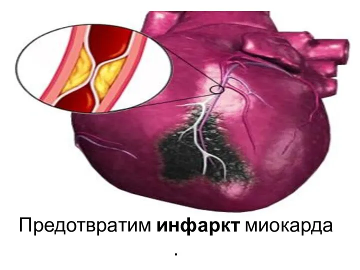 Предотвратим инфаркт миокарда.