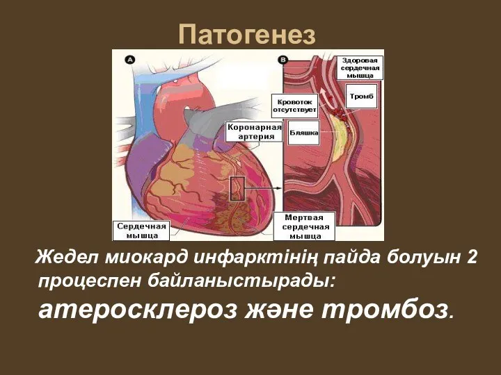 Патогенез Жедел миокард инфарктінің пайда болуын 2 процеспен байланыстырады: атеросклероз және тромбоз.