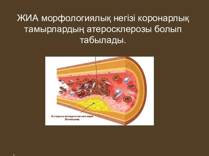 ЖИА морфологиялық негізі коронарлық тамырлардың атеросклерозы болып табылады. .