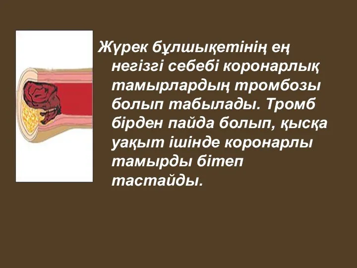 Жүрек бұлшықетінің ең негізгі себебі коронарлық тамырлардың тромбозы болып табылады. Тромб бірден пайда