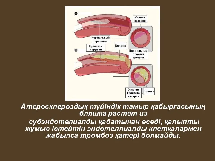 Атеросклероздық түйіндік тамыр қабырғасының бляшка растет из субэндотелиалды қабатынан өседі, қалыпты жұмыс істейтін