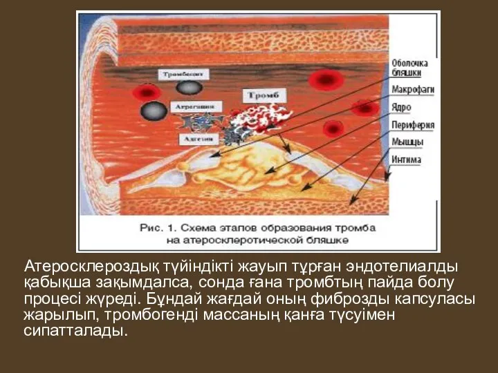 Атеросклероздық түйіндікті жауып тұрған эндотелиалды қабықша зақымдалса, сонда ғана тромбтың