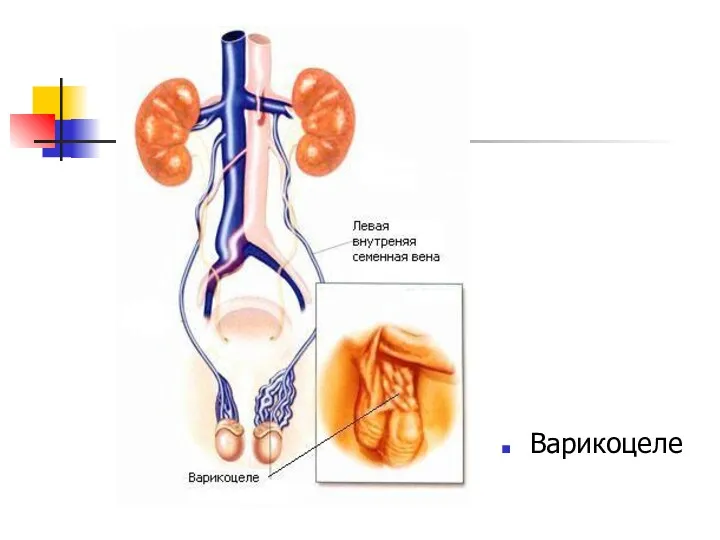 Варикоцеле