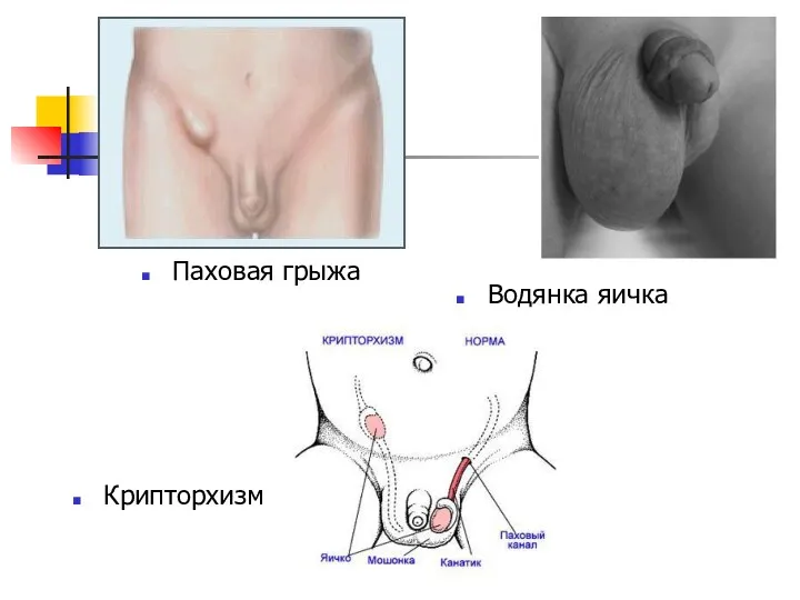 Паховая грыжа Крипторхизм Водянка яичка