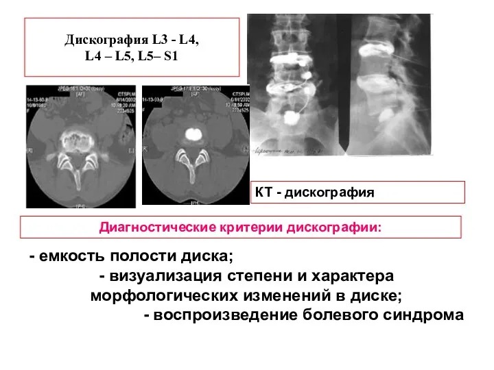 Дискография L3 - L4, L4 – L5, L5– S1 КТ