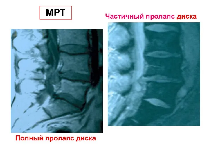 Частичный пролапс диска Полный пролапс диска МРТ