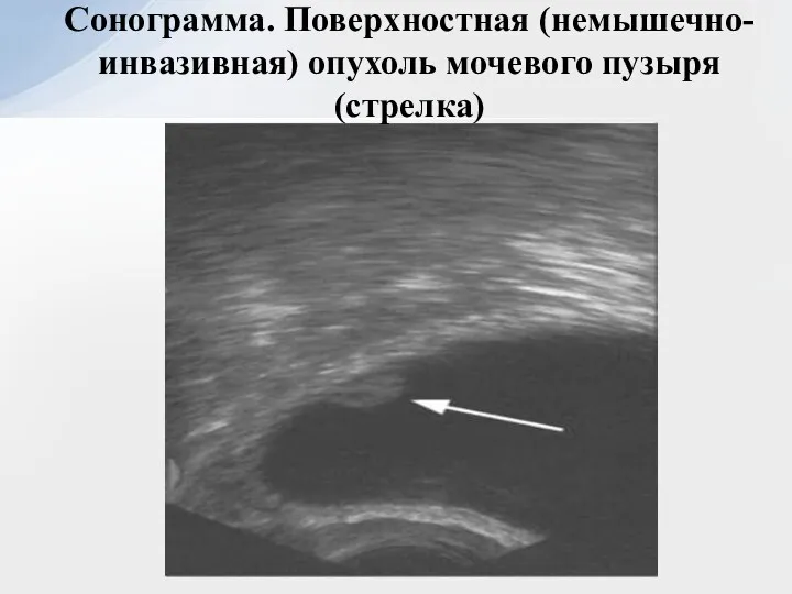 Сонограмма. Поверхностная (немышечно-инвазивная) опухоль мочевого пузыря (стрелка)