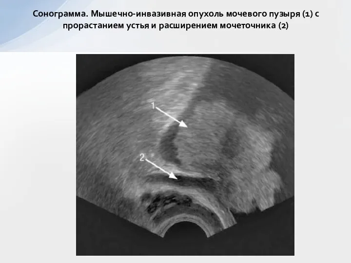 Сонограмма. Мышечно-инвазивная опухоль мочевого пузыря (1) с прорастанием устья и расширением мочеточника (2)