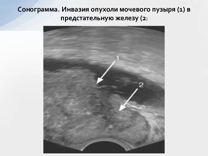 Сонограмма. Инвазия опухоли мочевого пузыря (1) в предстательную железу (2)