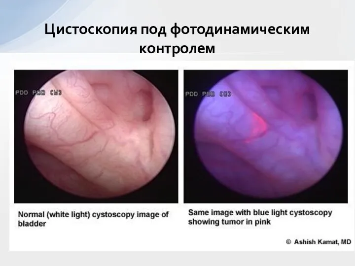 Цистоскопия под фотодинамическим контролем