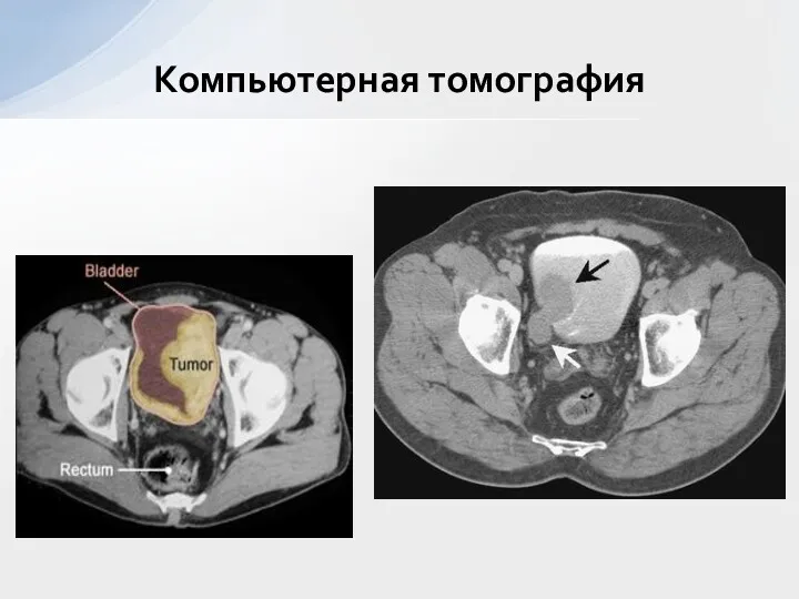 Компьютерная томография