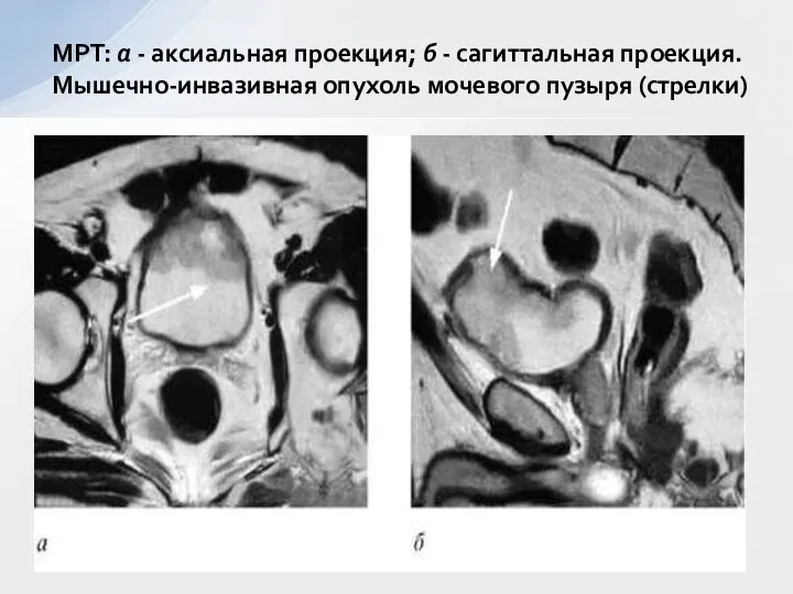 МРТ: а - аксиальная проекция; б - сагиттальная проекция. Мышечно-инвазивная опухоль мочевого пузыря (стрелки)