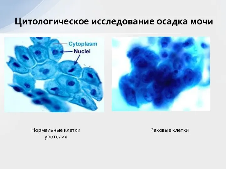 Цитологическое исследование осадка мочи Нормальные клетки уротелия Раковые клетки