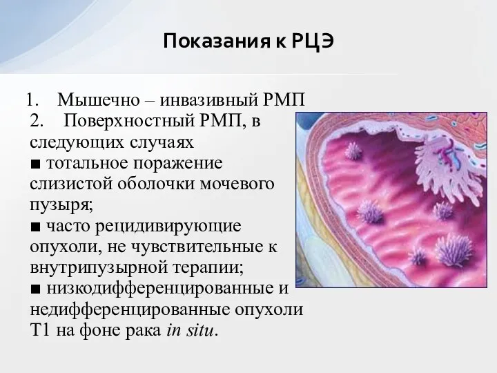 Мышечно – инвазивный РМП 2. Поверхностный РМП, в следующих случаях