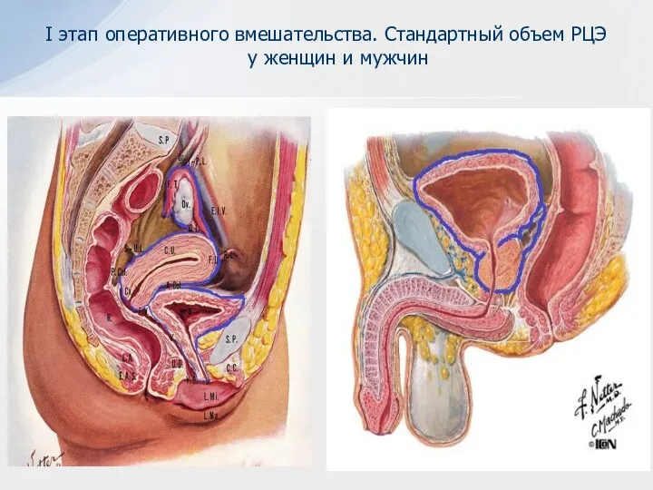 I этап оперативного вмешательства. Стандартный объем РЦЭ у женщин и мужчин