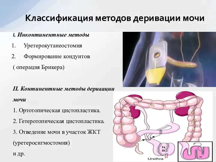 I. Инконтинентные методы Уретерокутанеостомия Формирование кондуитов ( операция Брикера) II.