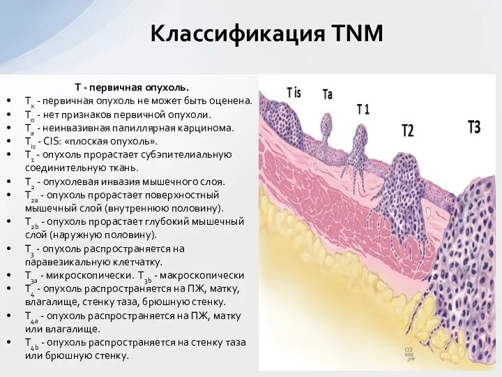 Т - первичная опухоль. Тх - первичная опухоль не может