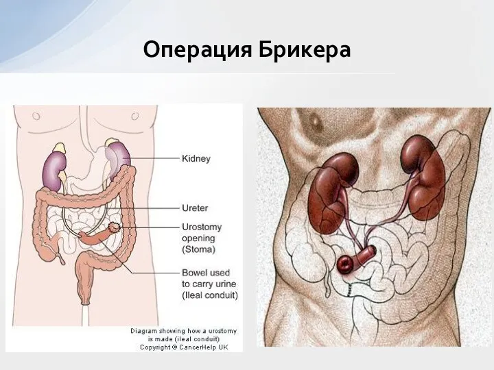 Операция Брикера