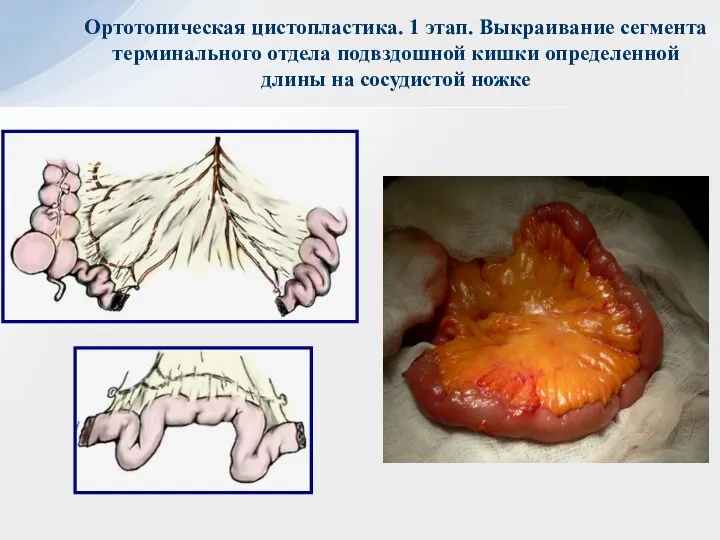 Ортотопическая цистопластика. 1 этап. Выкраивание сегмента терминального отдела подвздошной кишки определенной длины на сосудистой ножке