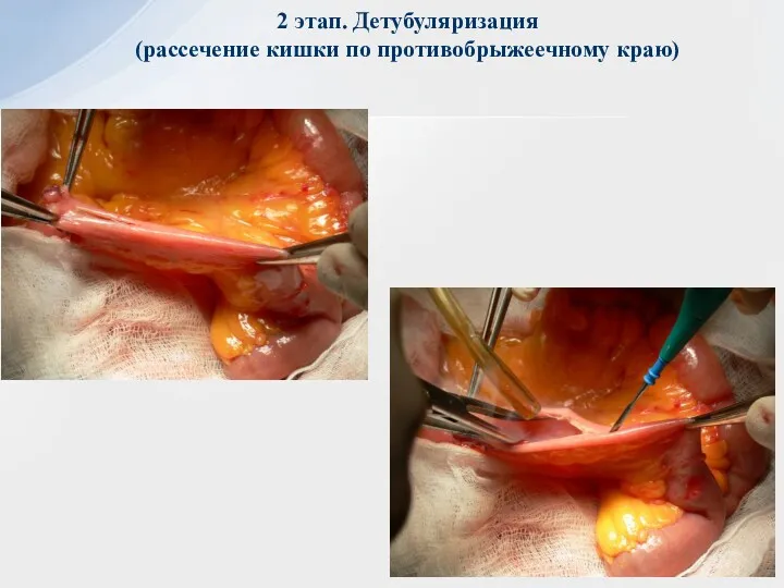 2 этап. Детубуляризация (рассечение кишки по противобрыжеечному краю)