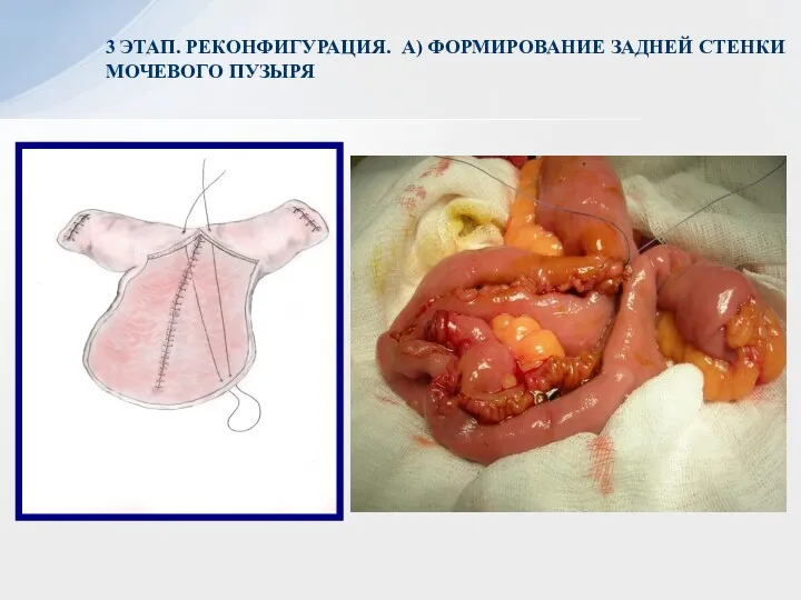3 ЭТАП. РЕКОНФИГУРАЦИЯ. А) ФОРМИРОВАНИЕ ЗАДНЕЙ СТЕНКИ МОЧЕВОГО ПУЗЫРЯ
