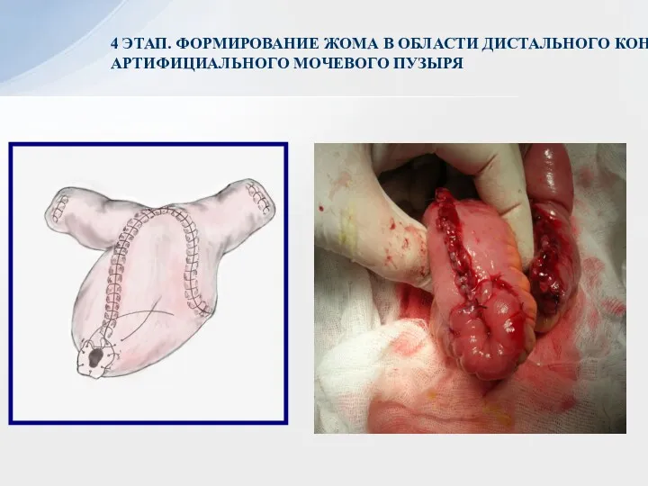 4 ЭТАП. ФОРМИРОВАНИЕ ЖОМА В ОБЛАСТИ ДИСТАЛЬНОГО КОНЦА АРТИФИЦИАЛЬНОГО МОЧЕВОГО ПУЗЫРЯ