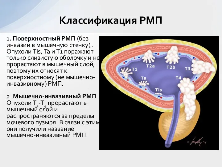 1. Поверхностный РМП (без инвазии в мышечную стенку) . Опухоли