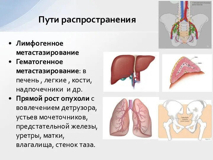 Лимфогенное метастазирование Гематогенное метастазирование: в печень , легкие , кости,