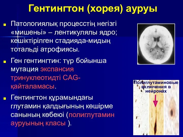 Гентингтон (хорея) ауруы Патологиялық процесстің негізгі «мишеньі» – лентикулялы ядро;