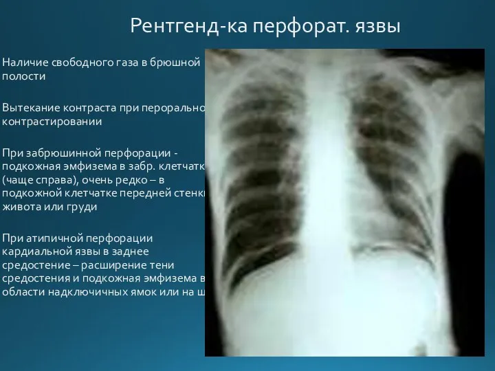Рентгенд-ка перфорат. язвы Наличие свободного газа в брюшной полости Вытекание
