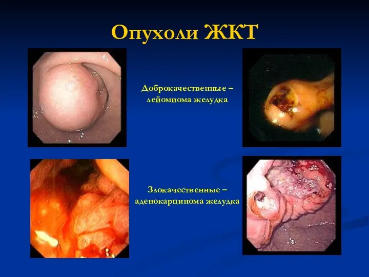 Опухоли ЖКТ Доброкачественные – лейомиома желудка Злокачественные – аденокарцинома желудка