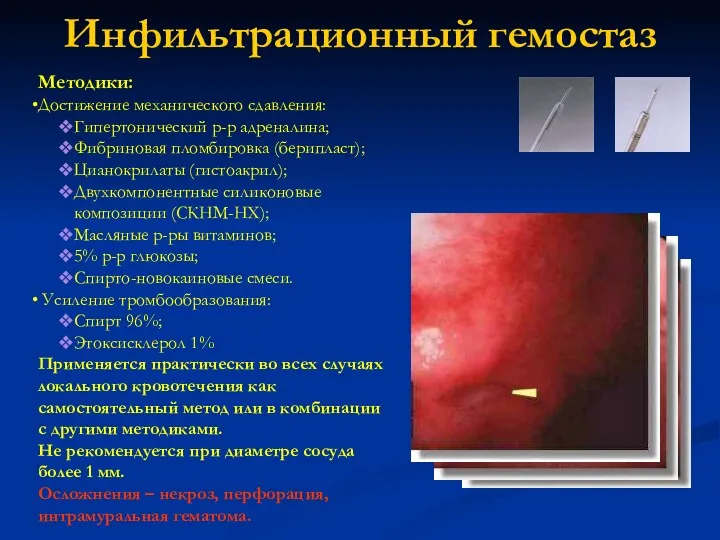 Инфильтрационный гемостаз Методики: Достижение механического сдавления: Гипертонический р-р адреналина; Фибриновая